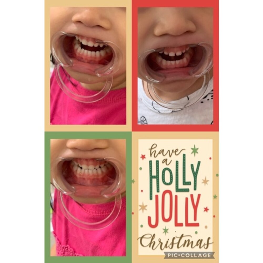 刷牙神器 張口器 ㄧ入(透明款)-圖片-1